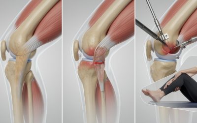 Ligament antéro latéral du genou : rôle, blessures et traitements